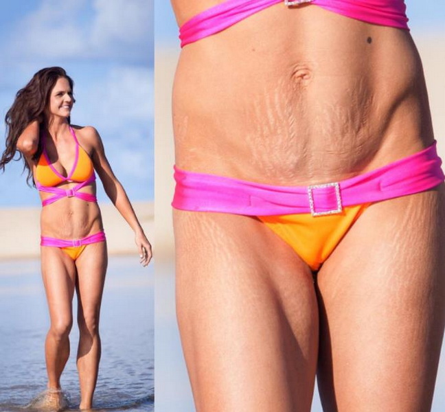 Should A Woman with Stretch Marks Wear A Bikini?