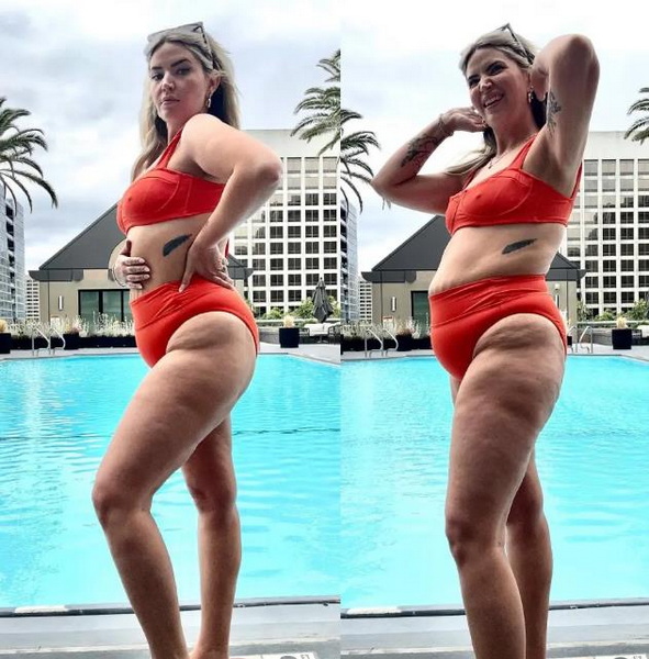 Should A Woman with Stretch Marks Wear A Bikini